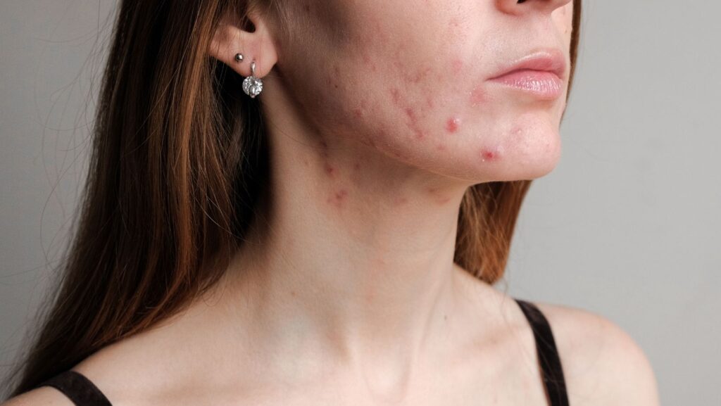 Hormonal Acne 1024x577